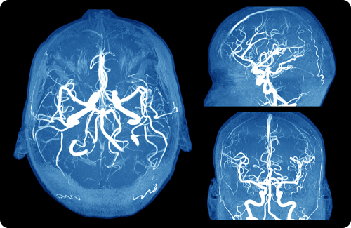 Фото МРТ вен головного мозга