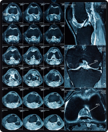 МРТ коленного сустава фото