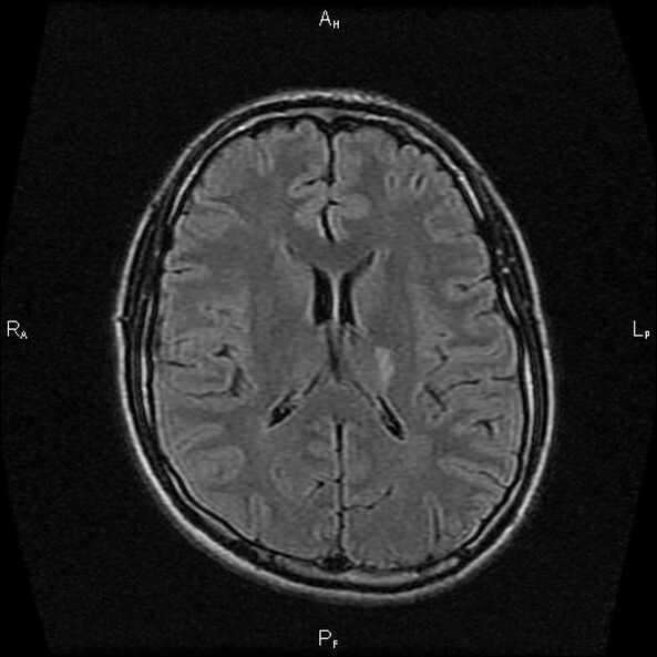 МРТ снимок инсульта