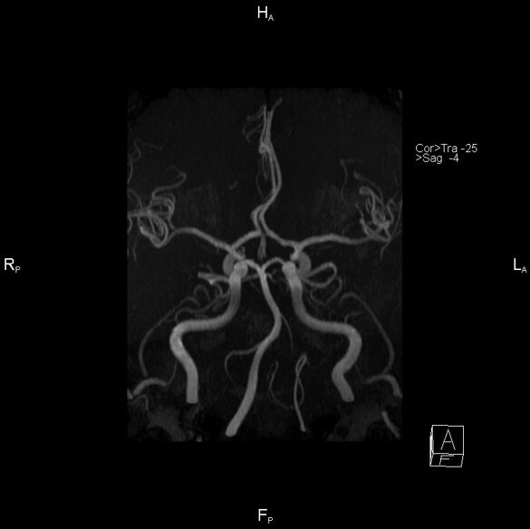 МРТ снимок синдрома позвоночной артерии