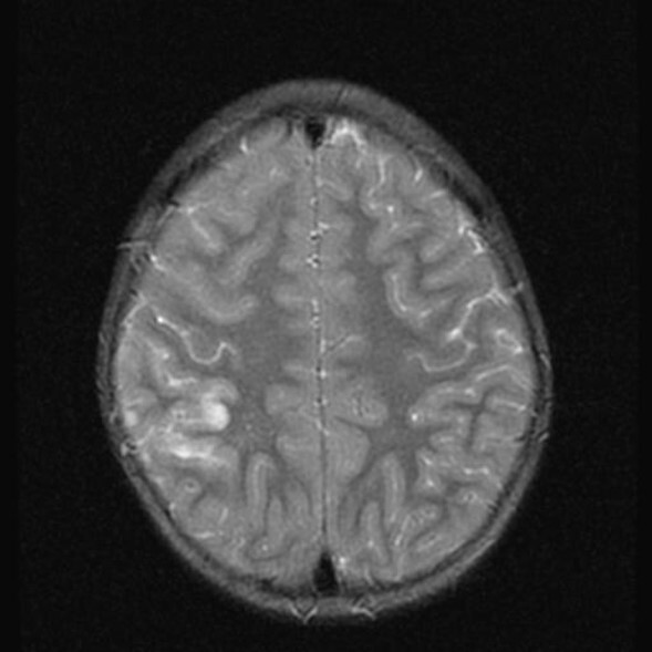 МРТ снимок ишемии головного мозга