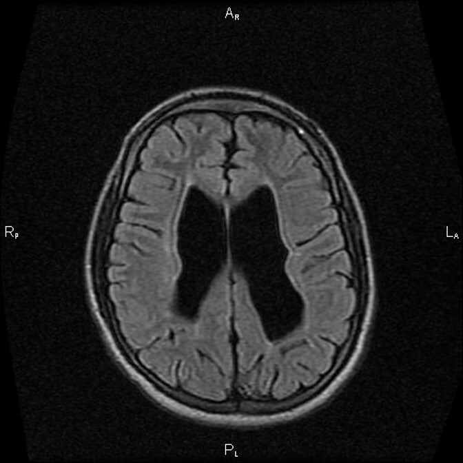 МРТ снимок внутричерепного давления
