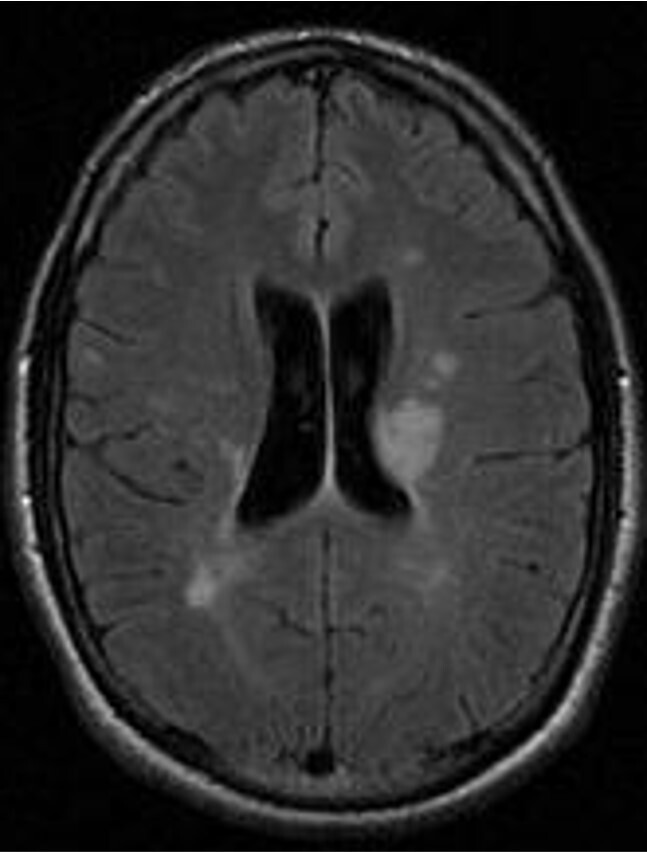 МРТ снимок рассеянного склероза