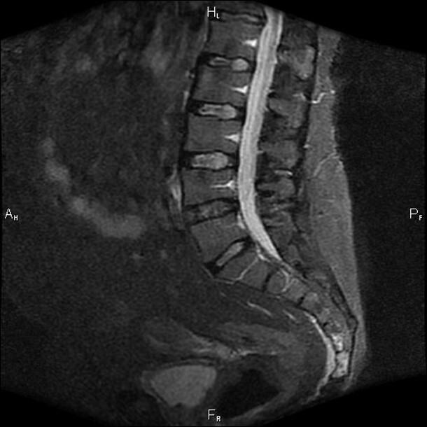 МРТ снимок перелома позвоночника