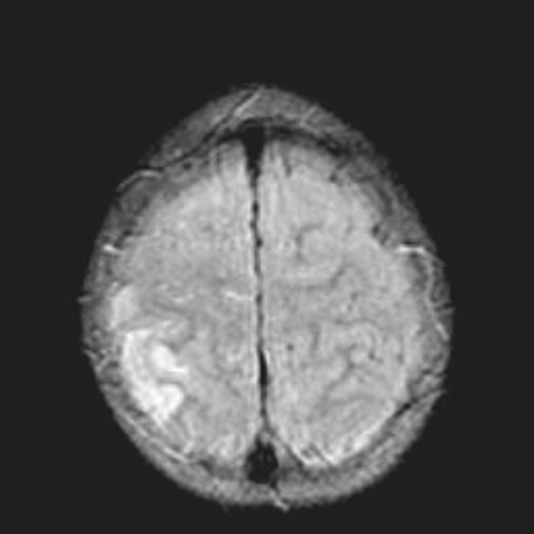 МРТ снимок ишемии головного мозга